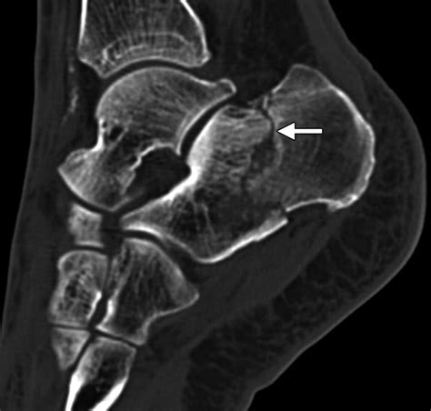 Multidetector Ct Evaluation Of Calcaneal Fractures Radiographics