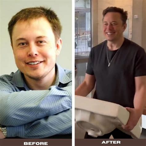 Elon Musk Hair Transplant: What You Should Know About The Procedure