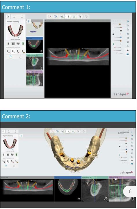 Guided Dental Implant Surgery In Gurgaon India: Unlocking The Precision ...