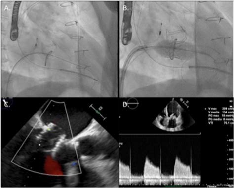 Main Steps Of The Implantation Procedure In A The Mitral Valve Was