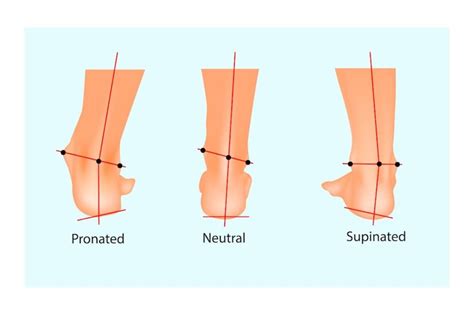 Fascitis Plantar Qué Es Tipos Y Tratamiento [con VÍdeo]