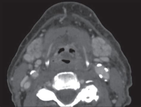 Review Of The Major And Minor Salivary Glands Part 1 Anatomy