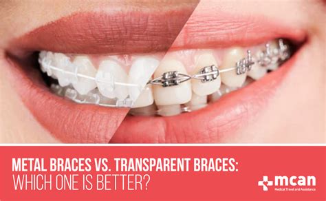 Ceramic Braces Vs Metal Braces