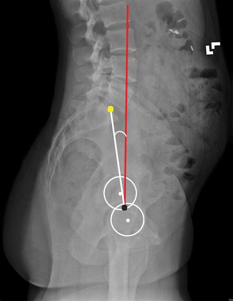 Pelvic Evaluation In Thoracolumbar Corrective Spine Surgery How I Do