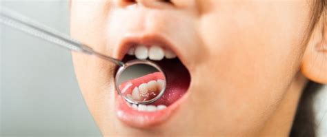 Qué es la caries cómo se trata y la importancia de prevenirla