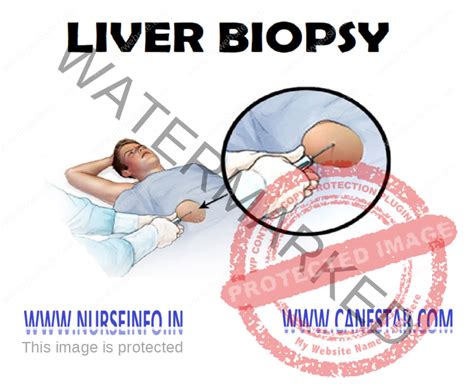 Liver Biopsy Nurse Info