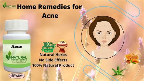 Make Your Acne Disappear Overnight with Helpful Home Remedies