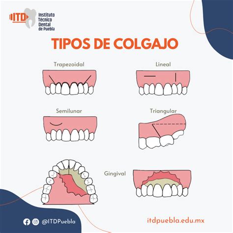 Colgajo OdontoGuías