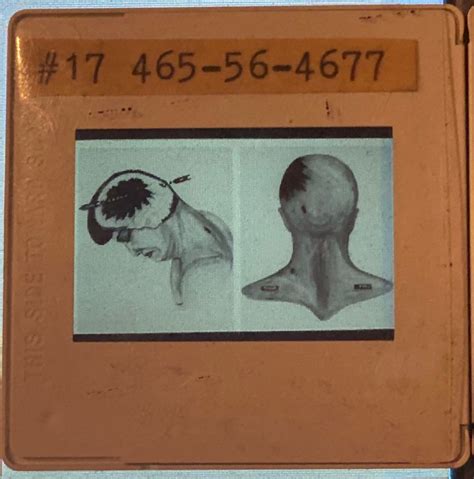 Slides Of Drawings Of Jfk Autopsy Photos Used In Warren Commission