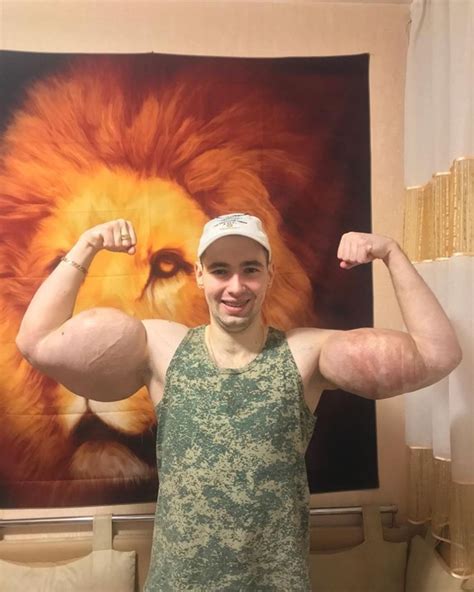 Lutador Que Injetou Litros De Synthol Nos Bra Os E Viu O B Ceps