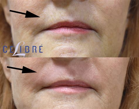 Upper Lip Botox Before And After