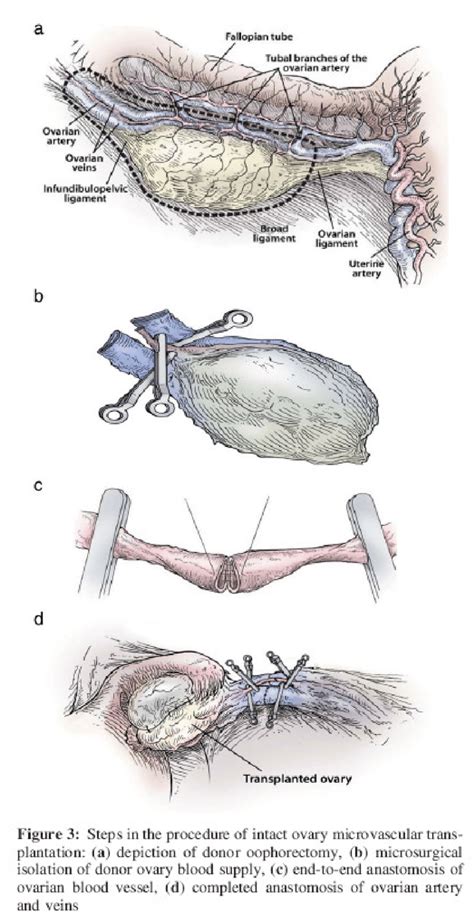 Diagrams from [109] demonstrating transplantation of whole human ovary ...