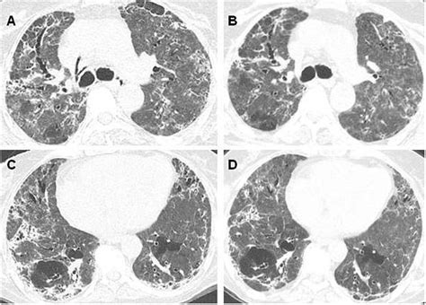 Current Understanding Of Post Covid Pulmonary Fibrosis Where Are We