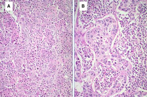 A B High Power View Of An Invasive Breast Cancer With Medullary