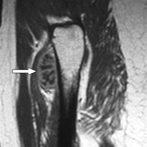 Chondrosarcoma Mri