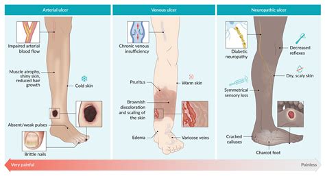 Venous Stasis Ulcer Vs Arterial Ulcer