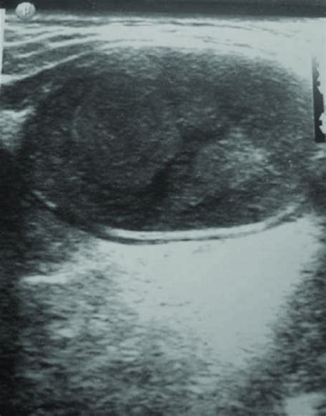 Dermoid Cyst A Sonogram Of The Floor Of Mouth Showing A Well Defined