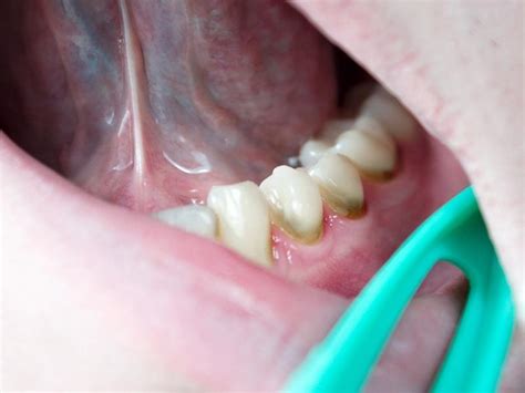 Cuáles son las enfermedades bucales más comunes Clínica Dental Rosa