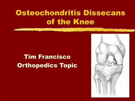 PPT Osteochondritis Dissecans Of The Knee PowerPoint Presentation