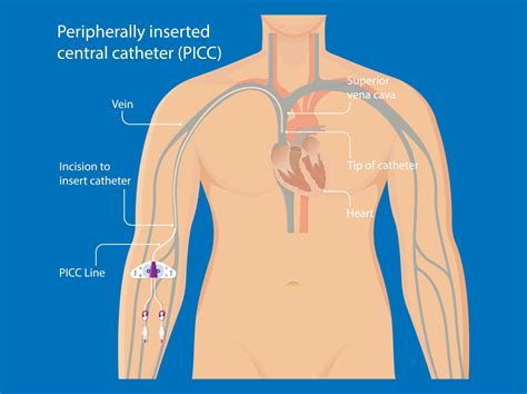 Central Line-Associated Bloodstream Infection | Gillette Children's