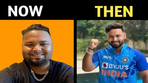 Rishabh Pant Face After Plastic Surgery Rishabh Pant Face After