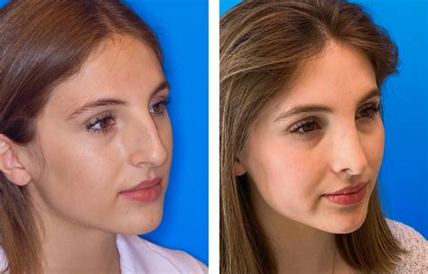 Nose Correction Rhinoplasty