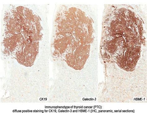 Pathology Outlines Papillary Thyroid Carcinoma Overview