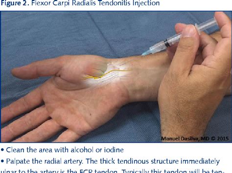 Basal Joint Corticosteroid Injection At Nickie Seton Blog