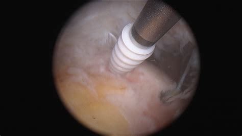 Risk Factors for Short-Term Complications After Rotator Cuff Repair in the United States ...