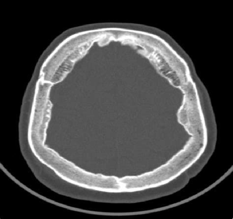 Figure 1 From Morgagni Stewart Morell Syndrome Presenting With