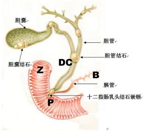 胆总管结石【多图】39医疗图集 39健康网