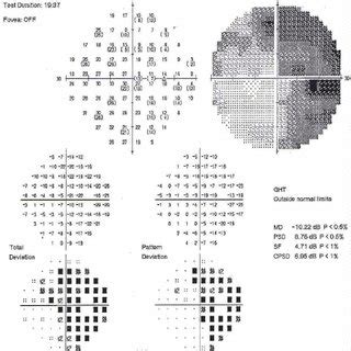 Humphrey visual field test shows right homonymous hemianopia and left ...