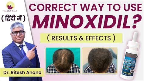 Right Way To Use Minoxidil For Best Result Effects And Types Of