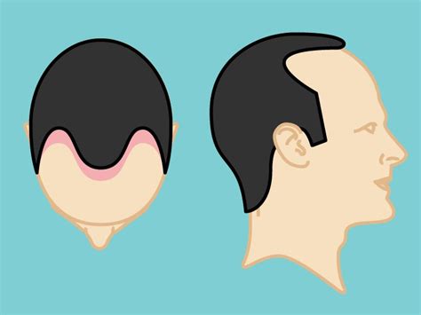 Norwood Scale: Pictures, Stages, Causes, and Treatment