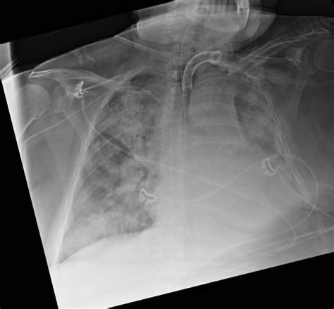 A case of cardiogenic pulmonary edema – NephroPOCUS