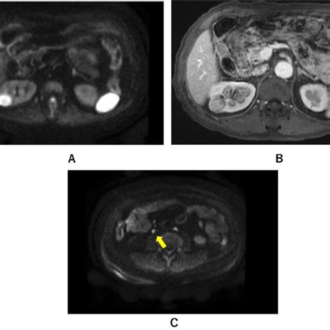 Axial Mri In A Dwi And B T Weighted Images At The Level Of The