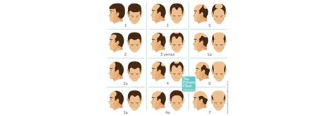 Hair Transplant Norwood Scale Hairline Temples Transplant Hair