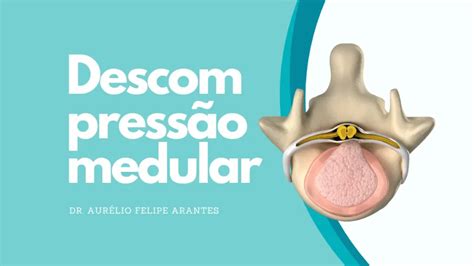 Descompress O Medular Entenda A Cirurgia