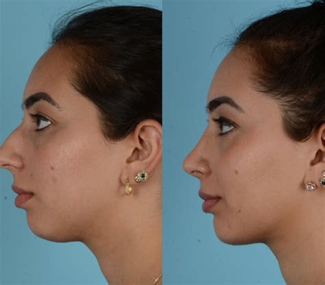 Before And After Plastic Surgery Results Top Surgeons Mexico