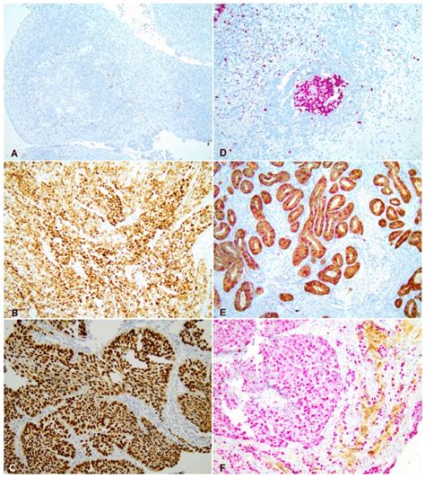 P53 And P16 Immunohistochemistry In Escc A Negative Control For P53 Download Scientific