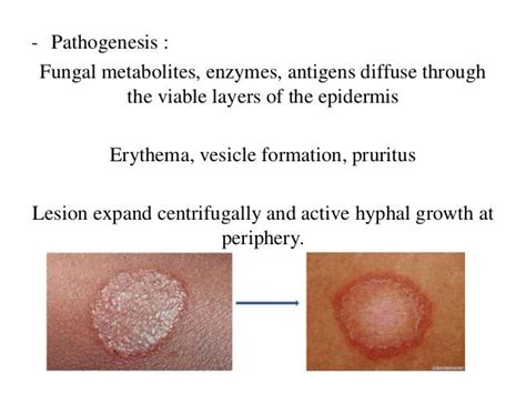 Dermatophytes