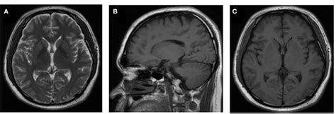 Neuroradiologic MRI. The MRI examination results of the patient were ...