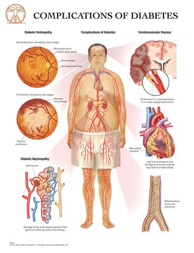 Complications Of Diabetes Anatomical Wall Chart Bsi Catalog