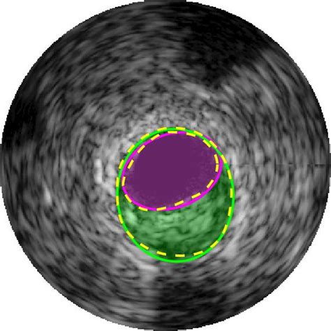 Segmentation Of Arterial Walls In Intravascular Ultrasound Cross Sectional Images Using Extremal