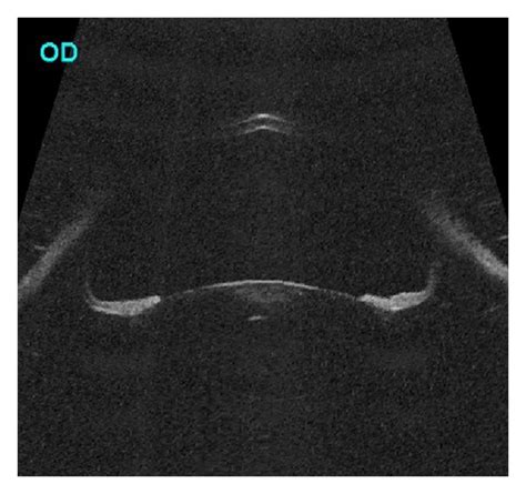 Ultrasound Biomicroscopy Axial Scan Of The Right Eye Showing