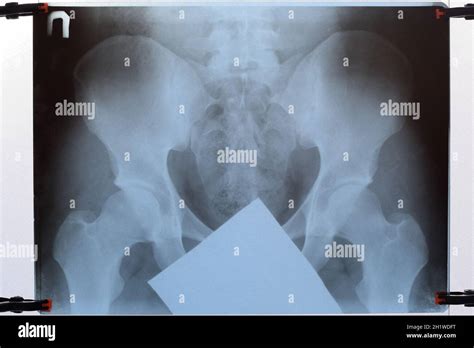 X-ray of the pelvis and sacrum. X-ray image Stock Photo - Alamy