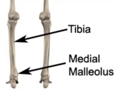 Medial Malleolus Fracture - Fractured Medial Malleolus - PhysioAdvisor