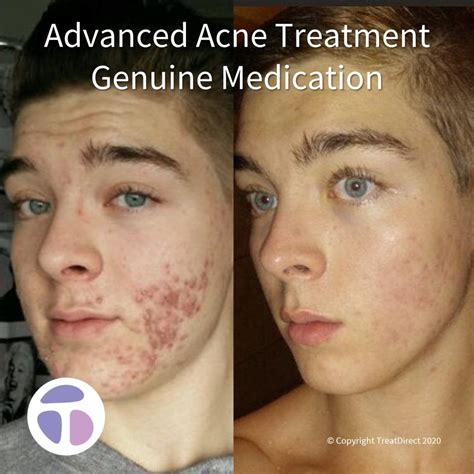 Accutane Before And After African American