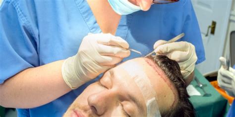 Afro Hair Transplantation In Turkey Asli Tarcan Clinic