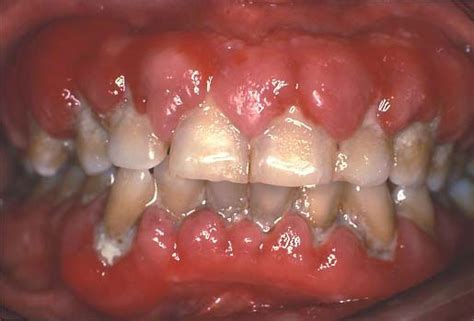 Gingival Enlargement Definition Of Gingival Enlargement